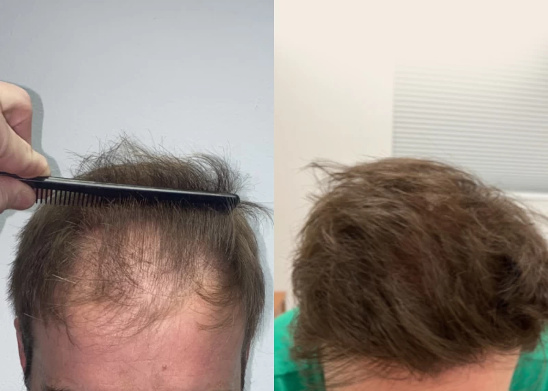 Patient p538 hair transplant before and after tilt view