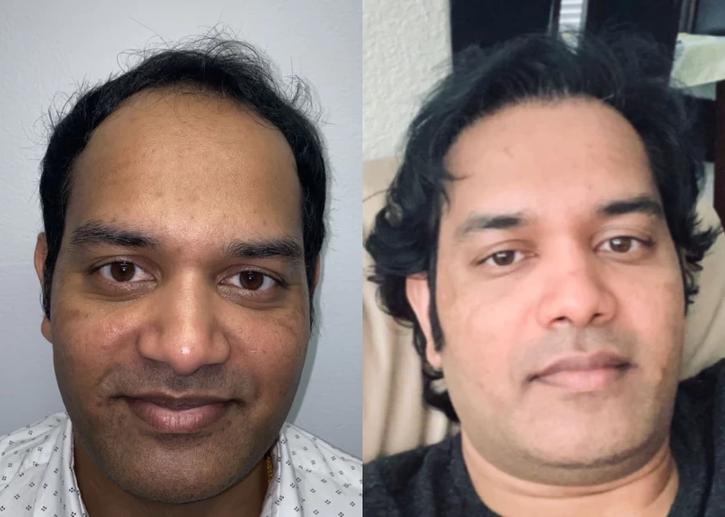 Patient 539 Hair Transplant Before and After