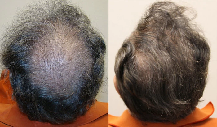 Patient p53 hair transplant before and after crown view