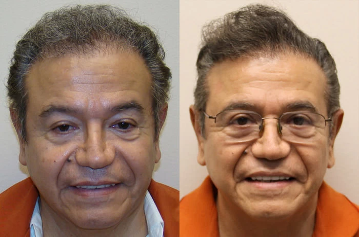 Galo Hair Transplant Before and After