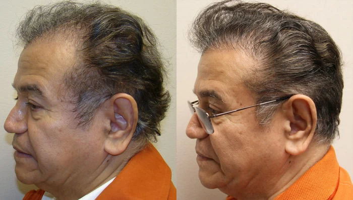 Patient p53 hair transplant before and after left view
