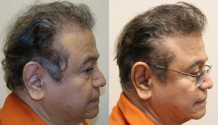Patient p53 hair transplant before and after right view
