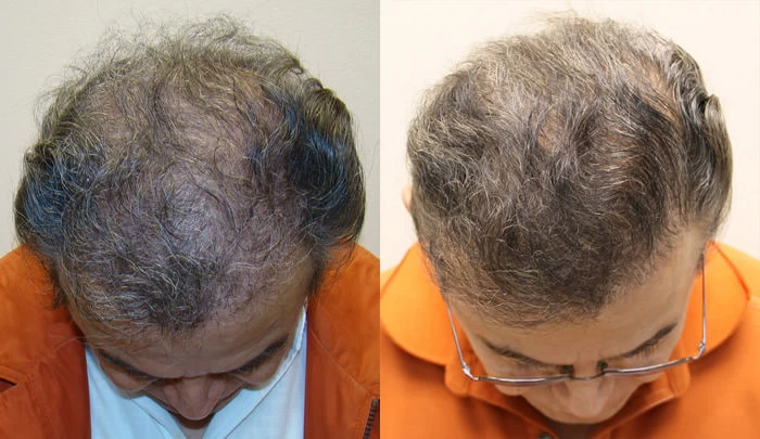 Patient p53 hair transplant before and after tilt view
