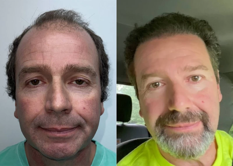 Patient 541 Hair Transplant Before and After