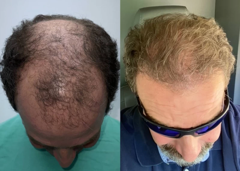 Patient p541 hair transplant before and after tilt view