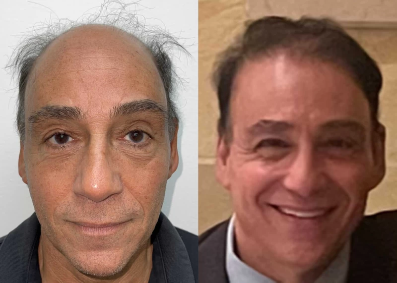 Patient 542 Hair Transplant Before and After