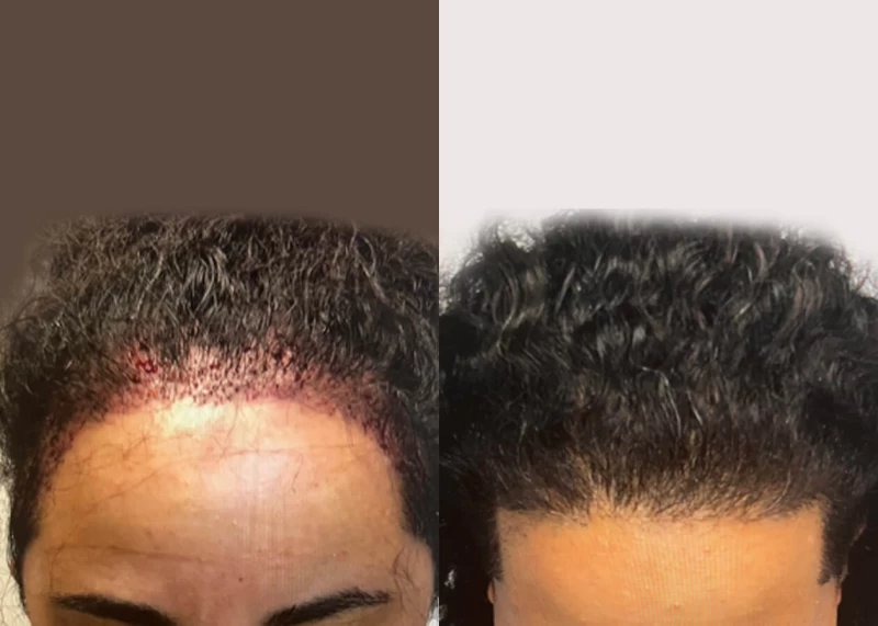 Patient 543 Hair Transplant Before and After
