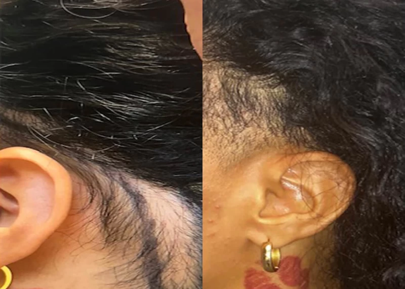 Patient p543 hair transplant before and after left view