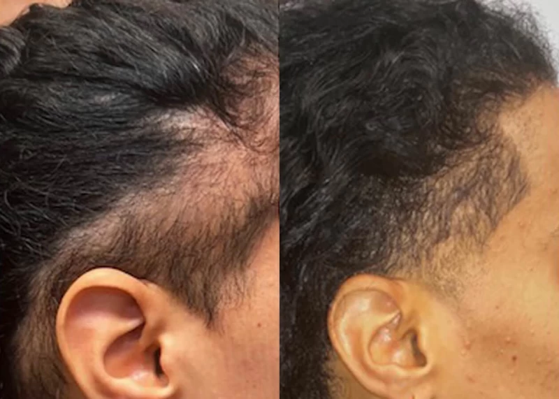 Patient p543 hair transplant before and after right view