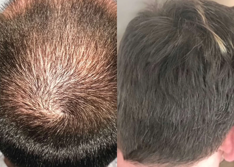 Patient p545 hair transplant before and after crown view