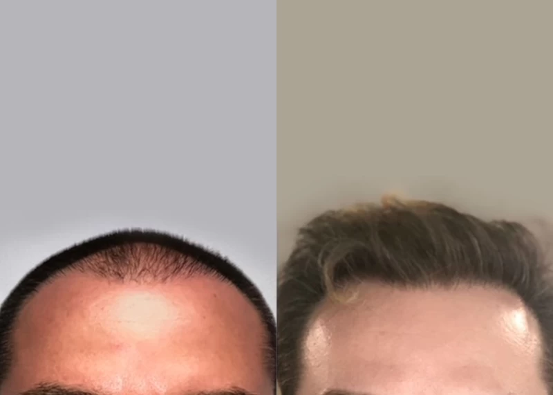 Patient 545 Hair Transplant Before and After