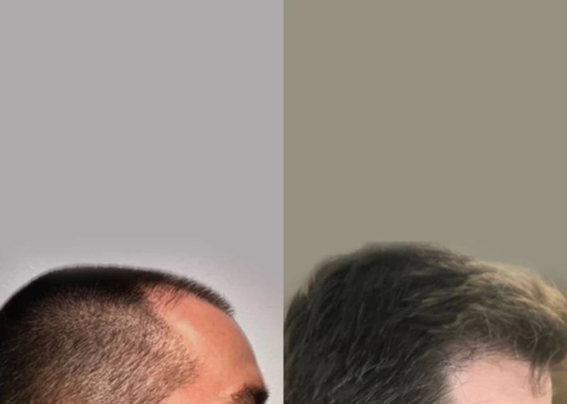 Patient p545 hair transplant before and after right view