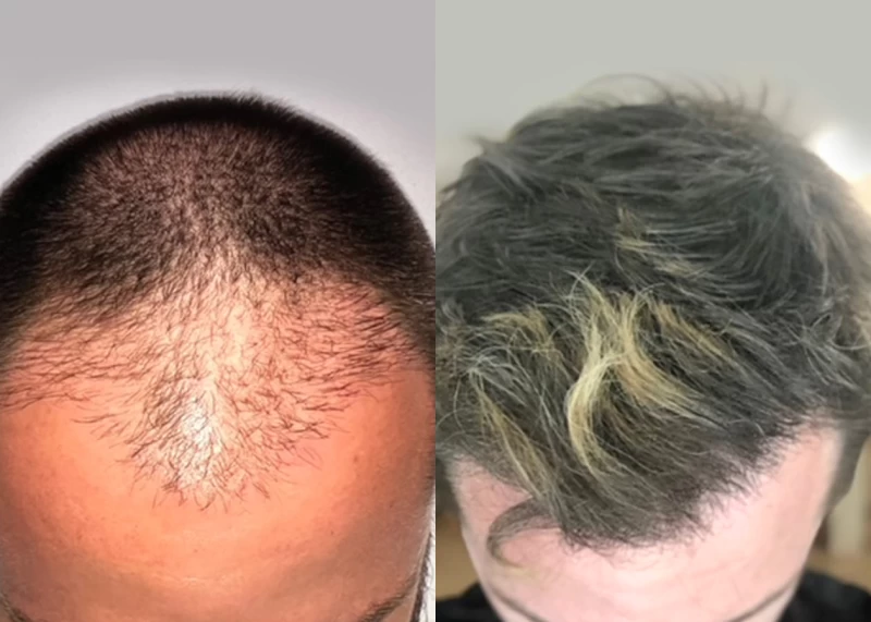 Patient p545 hair transplant before and after tilt view