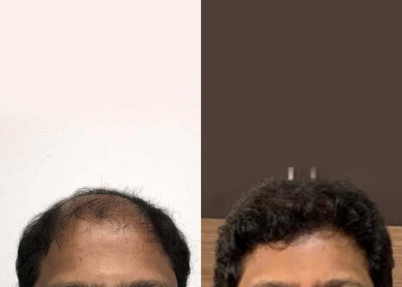 Patient 546 Hair Transplant Before and After