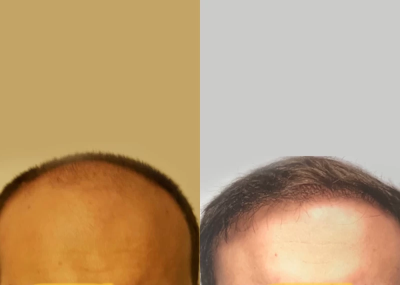 Patient 547 Hair Transplant Before and After