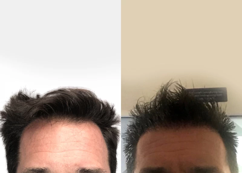 Patient 548 Hair Transplant Before and After