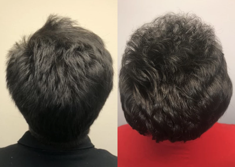 Patient p549 hair transplant before and after crown view