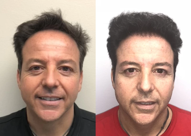 Patient 549 Hair Transplant Before and After