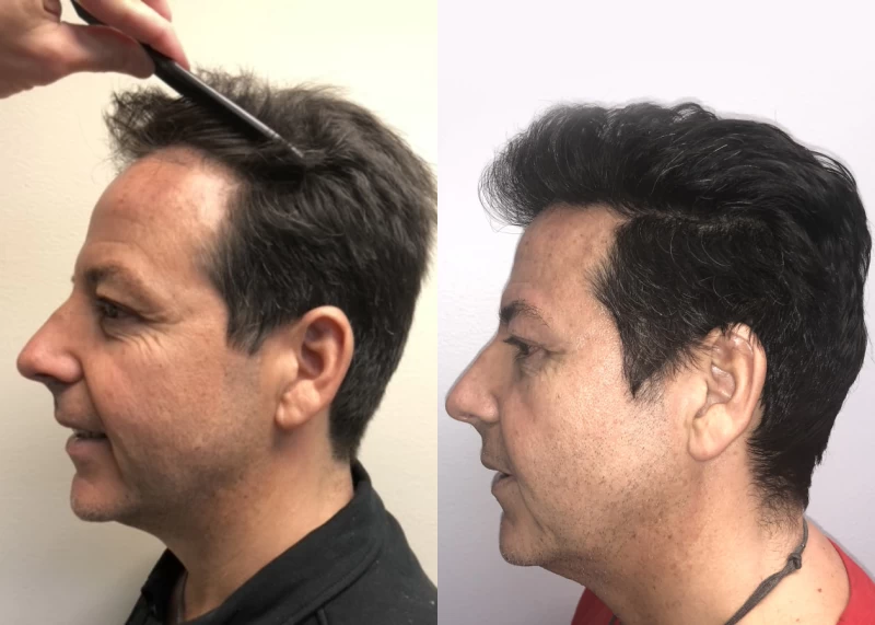 Patient p549 hair transplant before and after left view