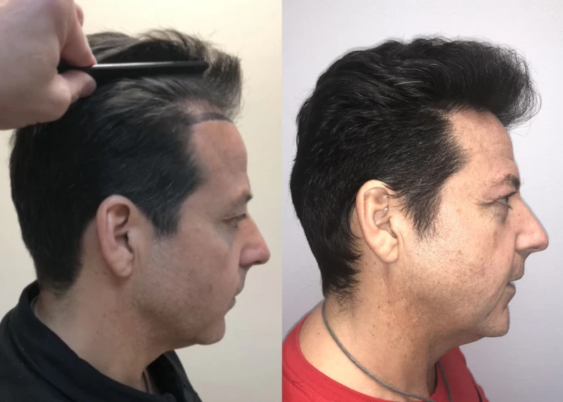 Patient p549 hair transplant before and after right view