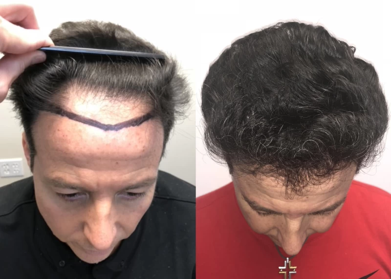 Patient p549 hair transplant before and after tilt view
