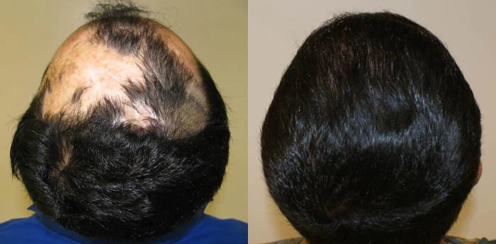 Patient p54 hair transplant before and after crown view