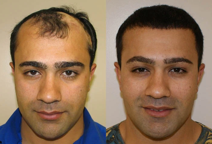 Rahim Hair Transplant Before and After