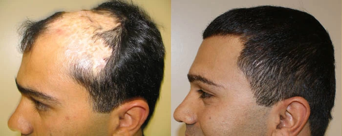Patient p54 hair transplant before and after left view
