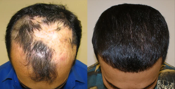 Rahim burn patient hair transplant before and after tilt view