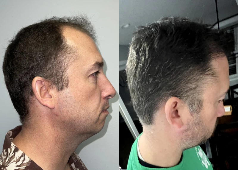 Patient p550 hair transplant before and after right view