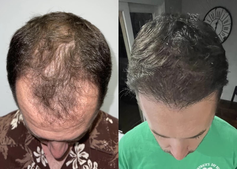 Patient 550 Hair Transplant Before and After