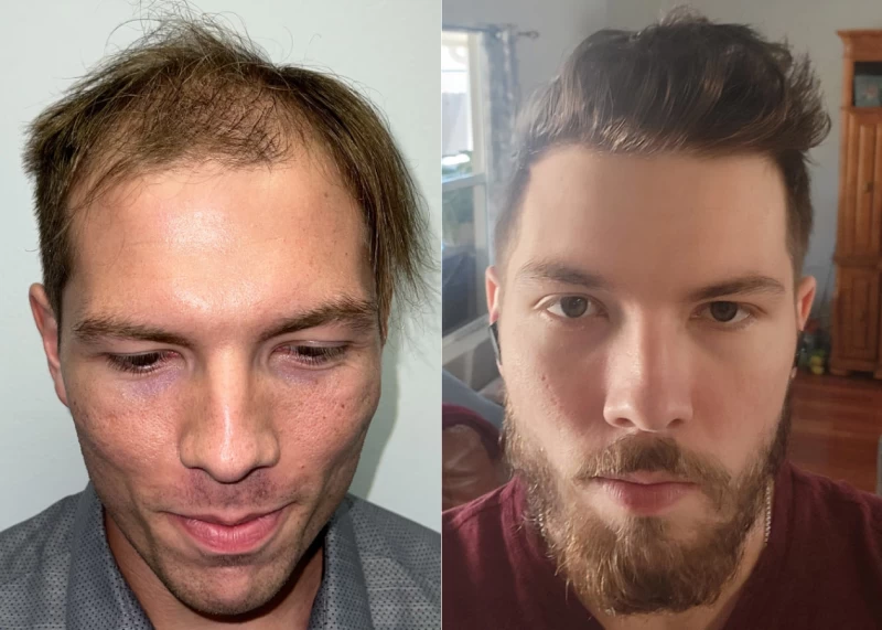 Nicolas Hair Transplant Before and After