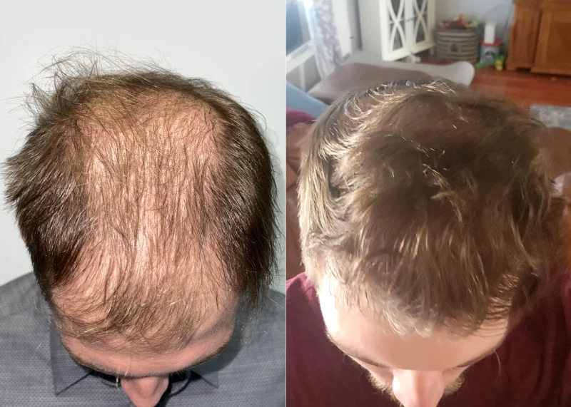 Patient p551 hair transplant before and after tilt view