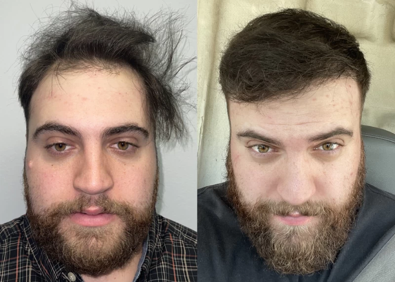 Nick Hair Transplant Before and After