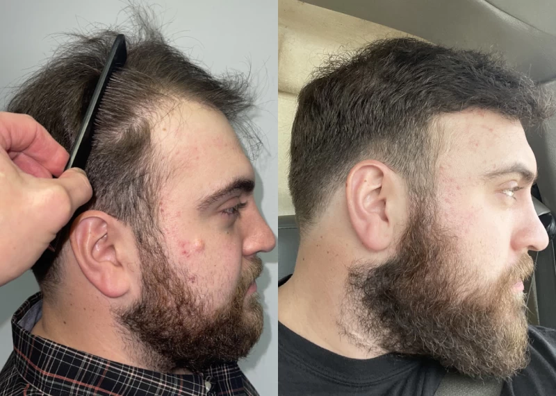 Patient p552 hair transplant before and after right view