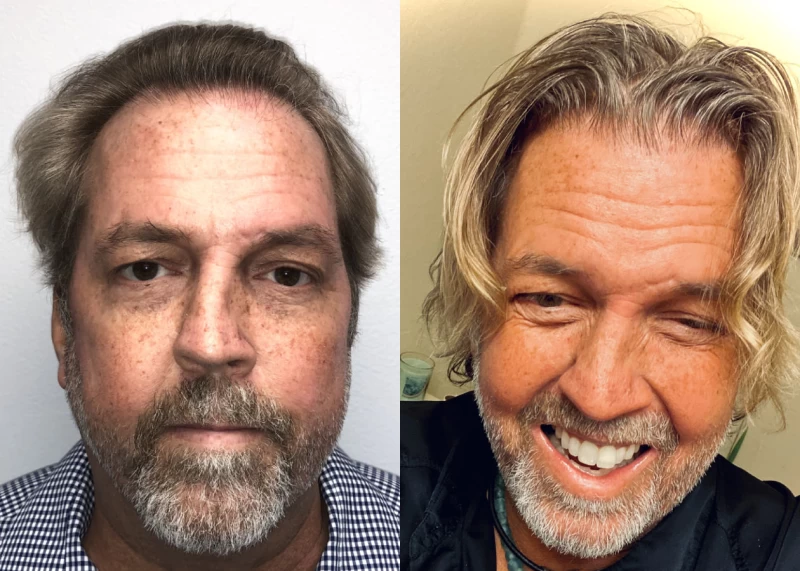 P553 Hair Transplant Before and After