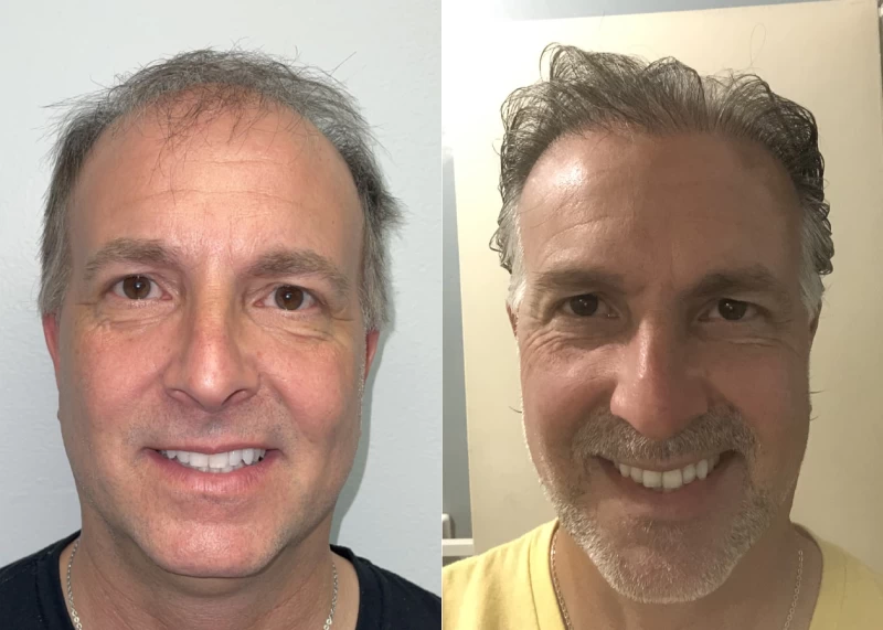 Chris Hair Transplant Before and After