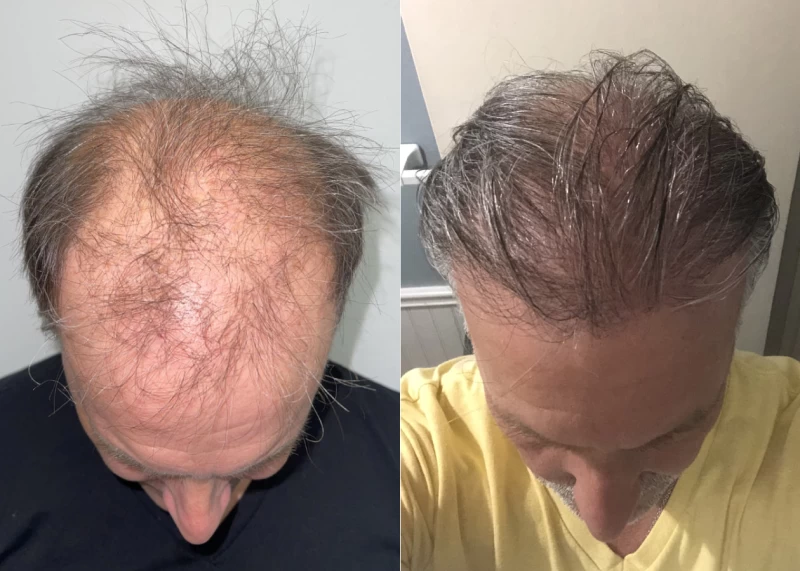 Patient p554 hair transplant before and after tilt view