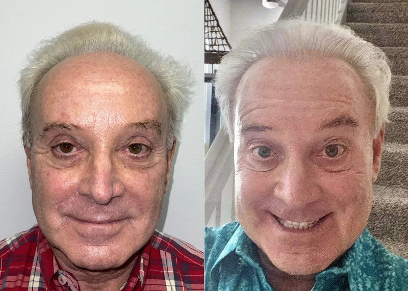 Patient 555 Hair Transplant Before and After