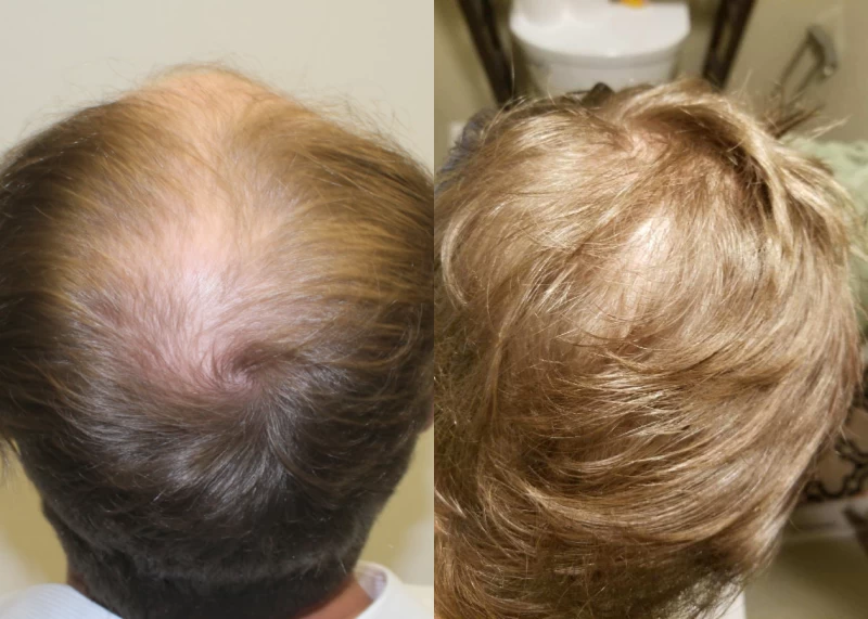 Patient p556 hair transplant before and after crown view