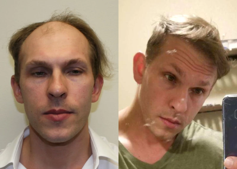 Vlad Hair Transplant Before and After