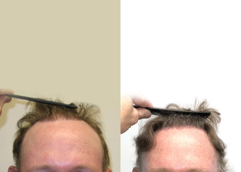 Patient 557 Hair Transplant Before and After