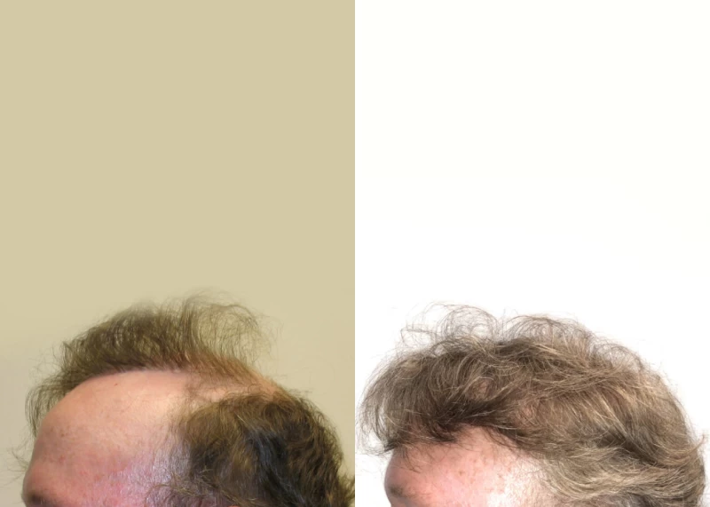 Patient p557 hair transplant before and after left view