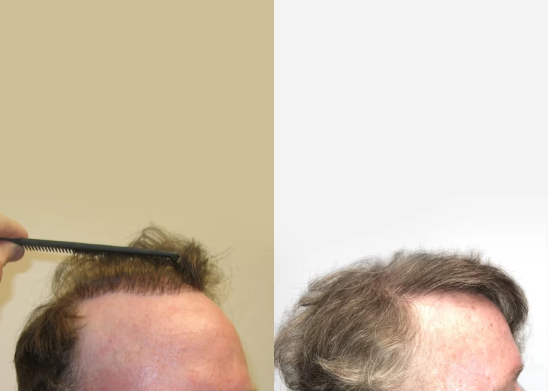 Patient p557 hair transplant before and after right view