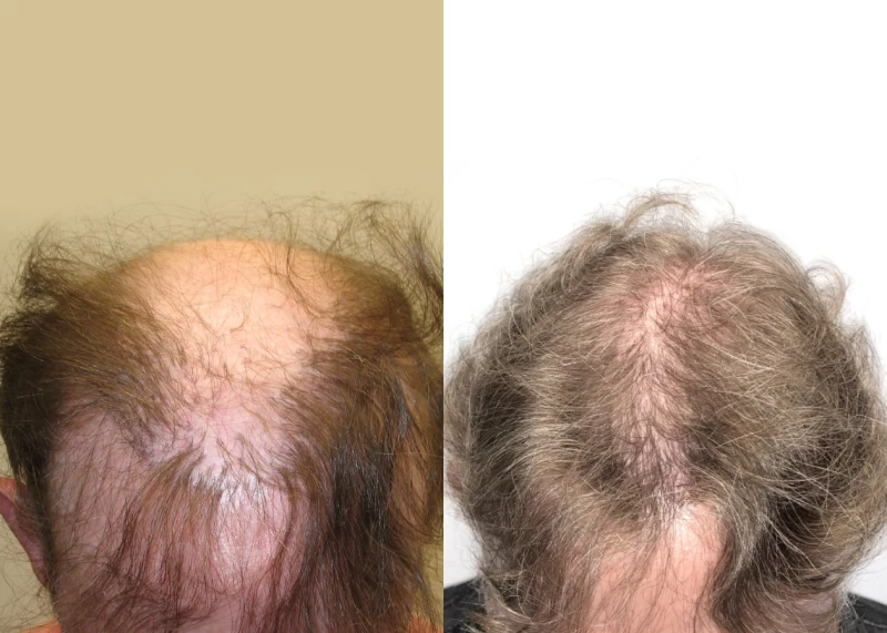 Patient p557 hair transplant before and after tilt view