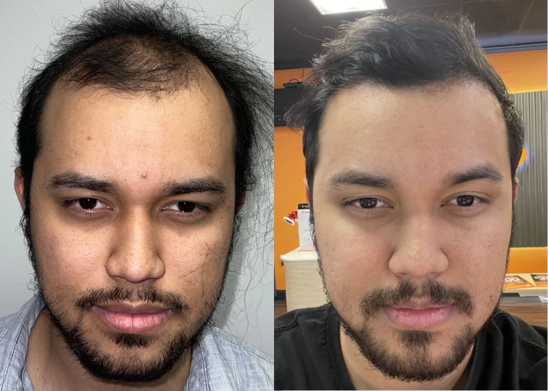 Raglan Hair Transplant Before and After