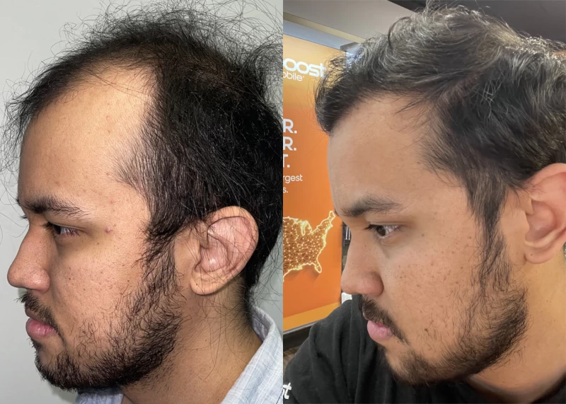 Patient p558 hair transplant before and after left view