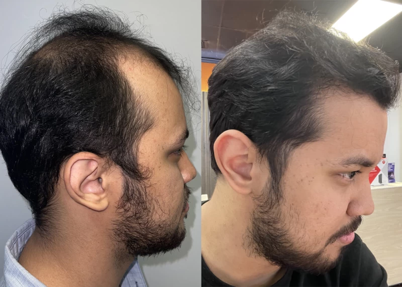 Patient p558 hair transplant before and after right view