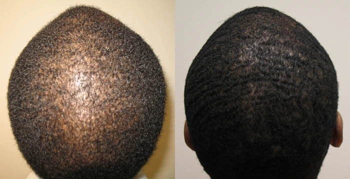 Patient p55 hair transplant before and after crown view
