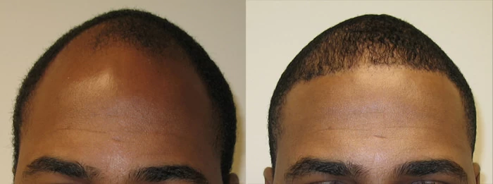 Patient 55 Hair Transplant Before and After